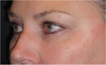 Restylane after 675897