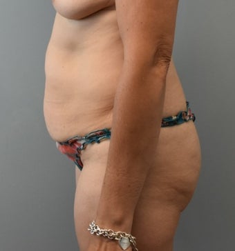 45-54 year old woman treated with Tummy Tuck before 3294102