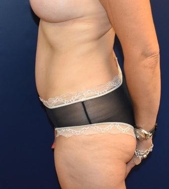45-54 year old woman treated with Tummy Tuck after 3294102