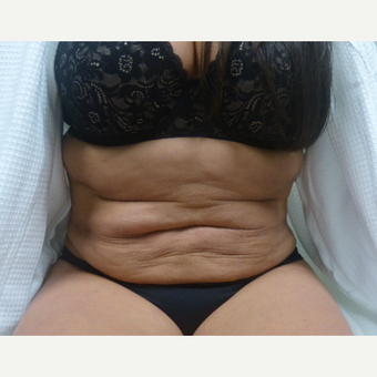 35-44 year old woman treated with Tummy Tuck before 3595824