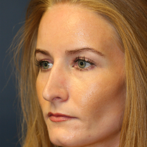 35-44 year old woman treated with Rhinoplasty before 3559722
