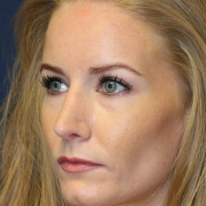 35-44 year old woman treated with Rhinoplasty after 3559722