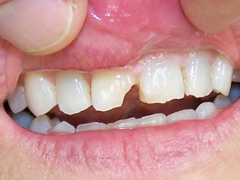 Bonding to Fix Chipped Front Tooth Before & After Photo before 996266
