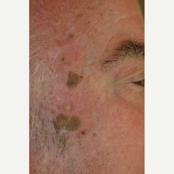 65-74 year old man treated with Age Spots Treatment before 1706433