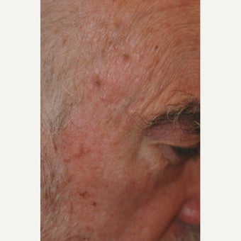 65-74 year old man treated with Age Spots Treatment after 1706433