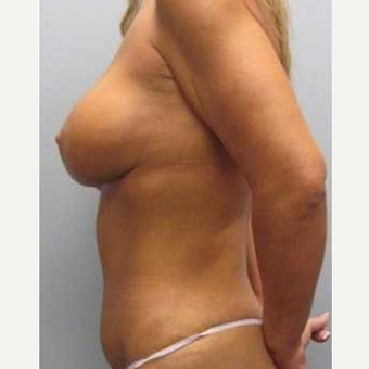 38 year old woman treated with Mommy Makeover after 3468542