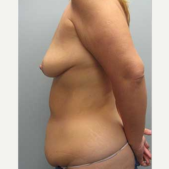 38 year old woman treated with Mommy Makeover before 3468542