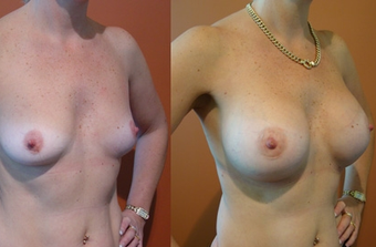 Breast Implants before 974226