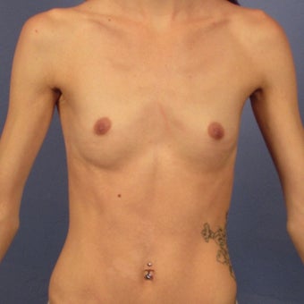 Breast Augmentation, 450cc High Profile, Dual Plane, Inframammary incision before 1940670