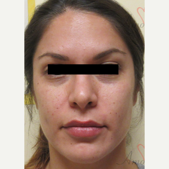 25-34 year old woman treated with Eye Bags Treatment before 3771446