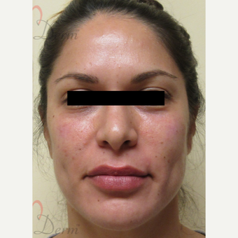 25-34 year old woman treated with Eye Bags Treatment after 3771446