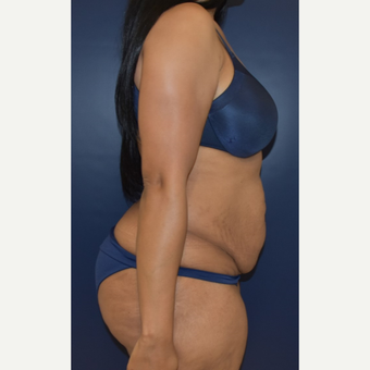 25-34 year old woman treated with Liposuction before 3844731
