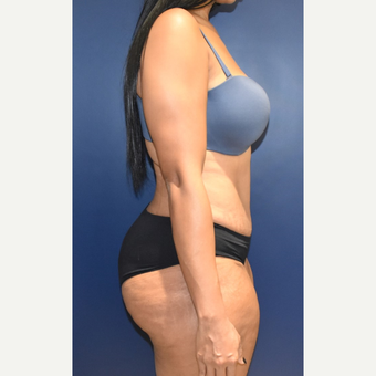 25-34 year old woman treated with Liposuction after 3844731