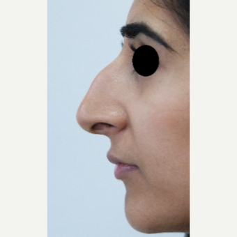25-34 year old woman treated with Rhinoplasty before 3637917