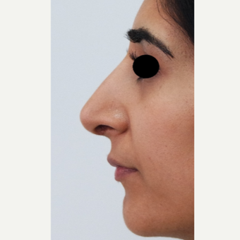 25-34 year old woman treated with Rhinoplasty after 3637917