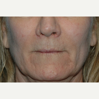 55-64 year old woman treated with Restylane before 3037716