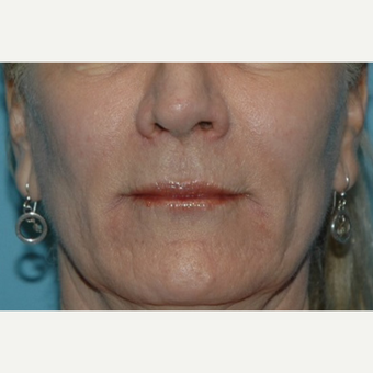 55-64 year old woman treated with Restylane after 3037716