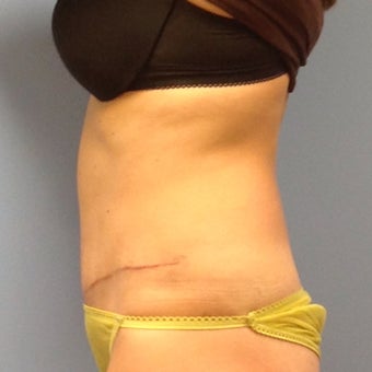 Woman treated with Tummy Tuck after Three Pregnancies after 2009774