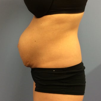 Woman treated with Tummy Tuck after Three Pregnancies before 2009774