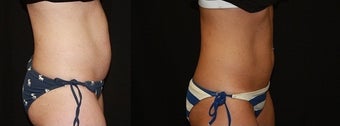 Coolsculpting before 615812