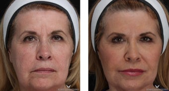 Voluma - A Natural Lift with Fillers before 1506644