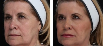Voluma - A Natural Lift with Fillers after 1506644