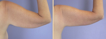 Arm Lift before 272272