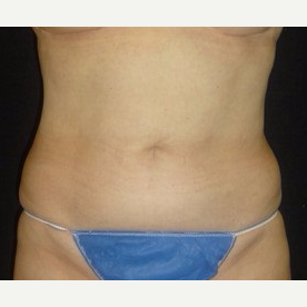 55-64 year old woman treated with CoolSculpting after 3181837