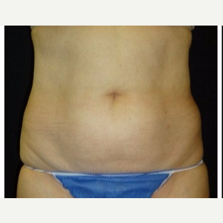 55-64 year old woman treated with CoolSculpting before 3181837