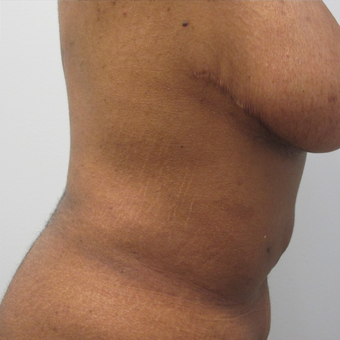 40 Year Old Female Liposuction of Abdomen, Waist, & Back 871074