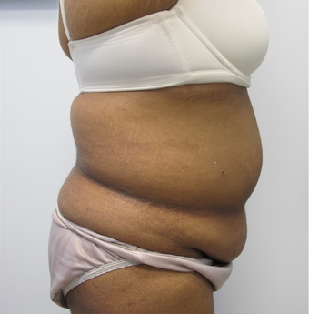 40 Year Old Female Liposuction of Abdomen, Waist, & Back 871074