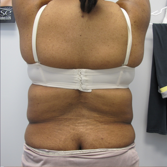 40 Year Old Female Liposuction of Abdomen, Waist, & Back before 871074