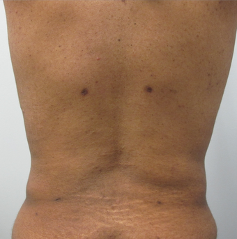 40 Year Old Female Liposuction of Abdomen, Waist, & Back after 871074
