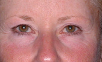 Ultherapy before 460619