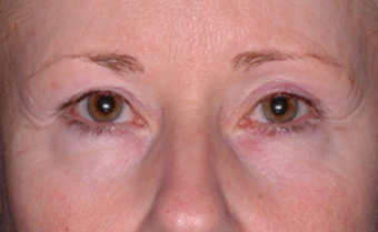 Ultherapy after 460619