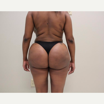 35-44 year old woman treated with Brazilian Butt Lift after 3338044