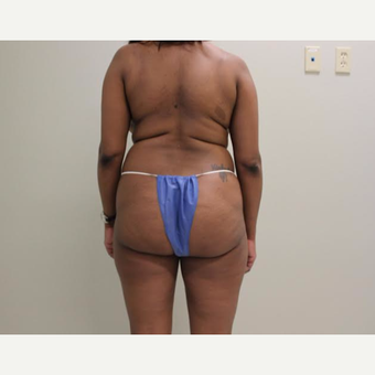 35-44 year old woman treated with Brazilian Butt Lift before 3338044