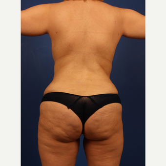 Liposuction after 3743843