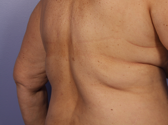 CoolSculpting to Bra Rolls/Back Fat before 375512