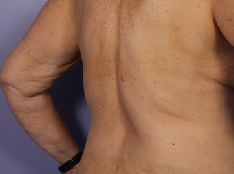 CoolSculpting to Bra Rolls/Back Fat after 375512