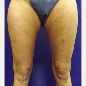 47 year old woman treated with SculpSure Non-Surgical Body Contouring before 2706305