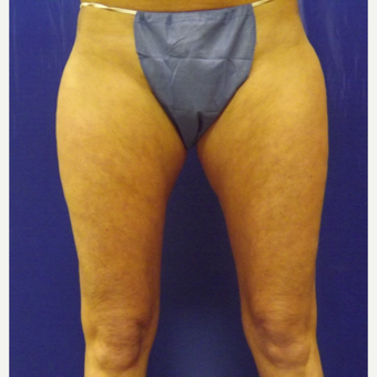 47 year old woman treated with SculpSure Non-Surgical Body Contouring after 2706305
