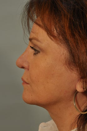 Revision Rhinoplasty after 886689