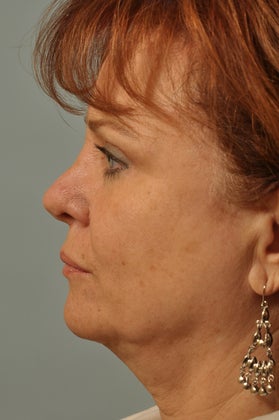 Revision Rhinoplasty before 886689