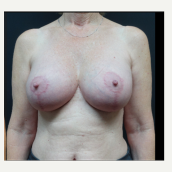 35-44 year old woman treated with Breast Implants after 3731571