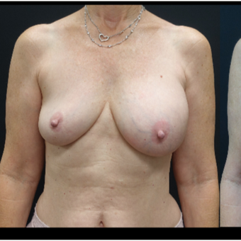 35-44 year old woman treated with Breast Implants before 3731571