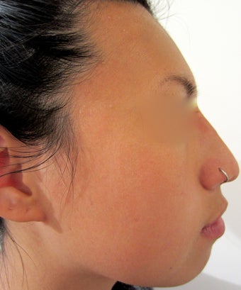 24 year-old female with nose hump treated with Restylane filler after 989340
