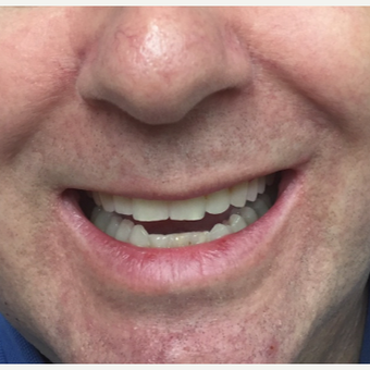 45-54 year old man treated with Invisalign after 3638299
