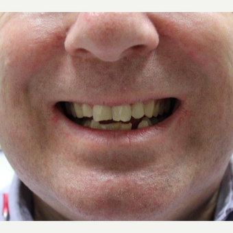 45-54 year old man treated with Invisalign before 3638299