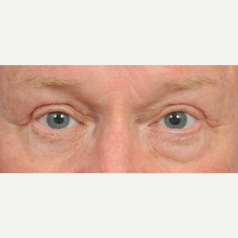 65-74 year old woman treated with Eyelid Surgery after 3441043